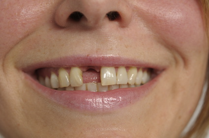 Folgen des Zahnverlustes